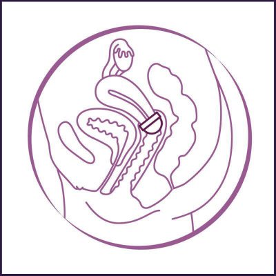 Pictogramm zur Positionierung einer FemCap über dem Uterus