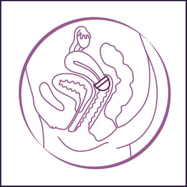 Pictogramm zur Positionierung einer FemCap über dem Uterus